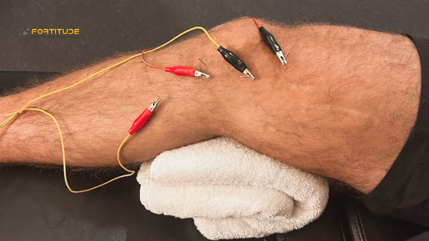 Dry needling with electrical stimulation on quad muscle at Fortitude Performance Chiropractic in Scottsdale
