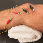 Dry needling with electrical stimulation on quad muscle at Fortitude Performance Chiropractic in Scottsdale